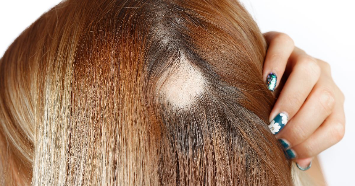 Come si riconosce e come si cura l’alopecia areata femminile?